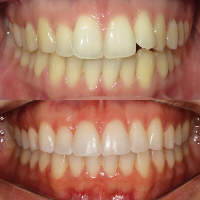 Invisalign antes e depois dentista vitória es