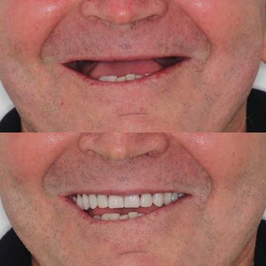 Protese protocolo antes e depois dentista vila velha es
